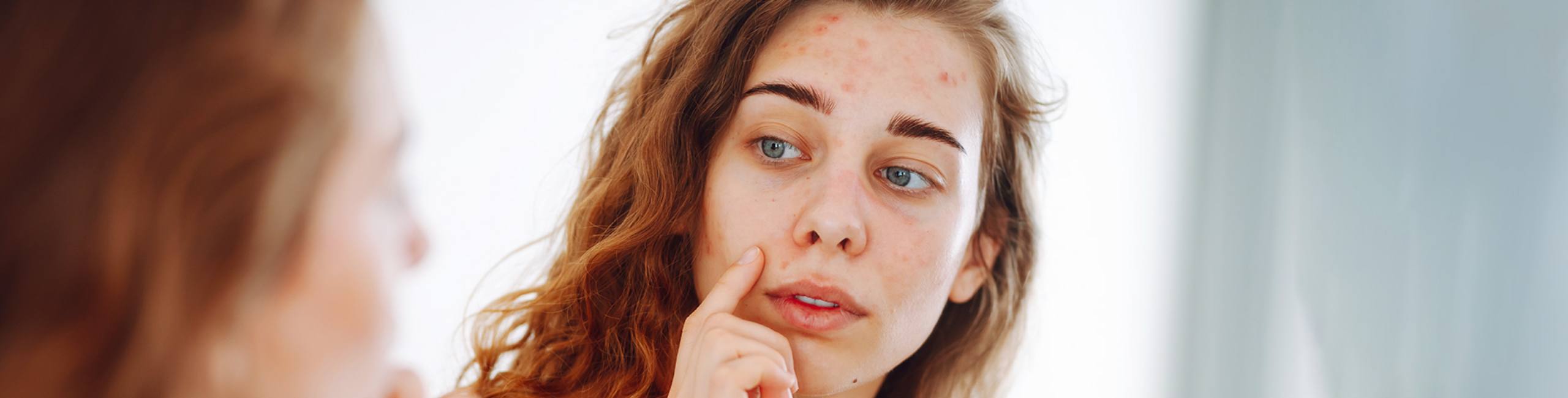 Mlada žena sa sindromom policističnih jajnika gleda svoje lice sklono aknama u ogledalu – Catafertyl