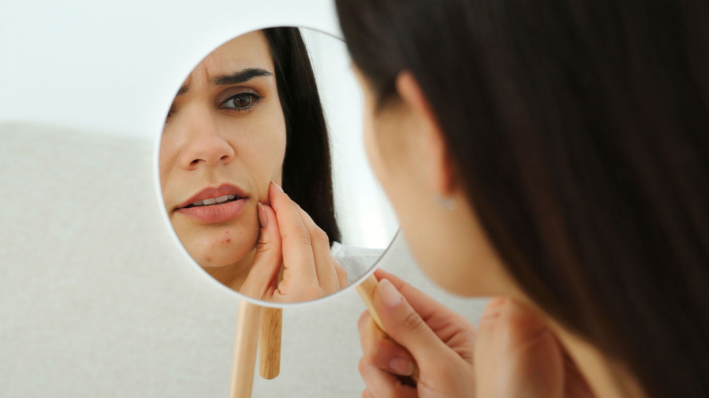 catafertyl-akne-u-ogledalu-RS