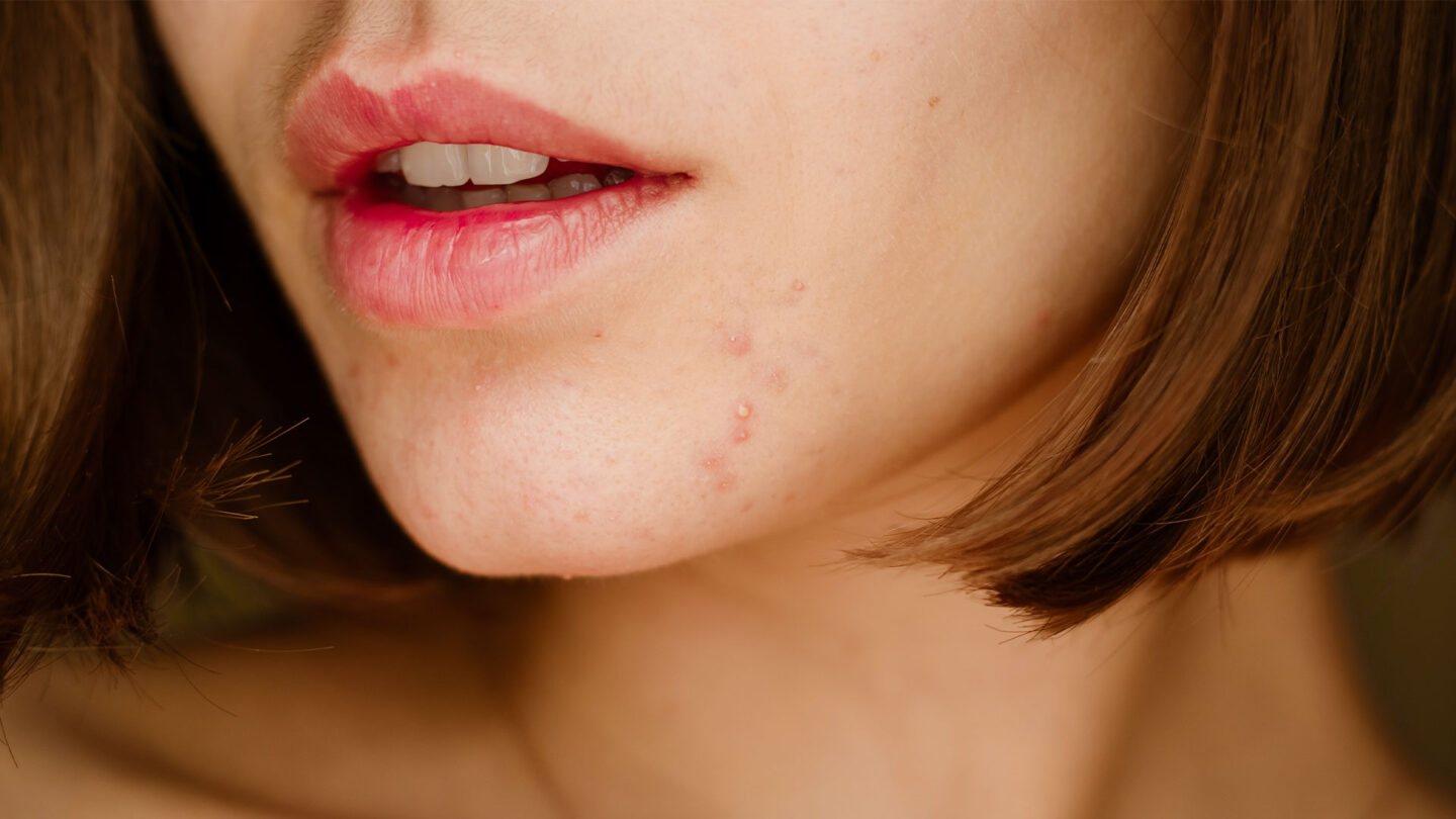 Žena sa PCOS-om i aknama na licu – Catafertyl